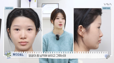 압구정 바바성형외과 자가늑 코성형 후기｜복코&middot;매부리코 교정 한달차 변화 관련 이미지 21