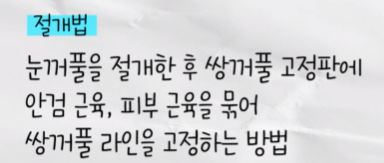 둔해보이는 눈매 무쌍 수술 전후 결과 알아보기 관련 이미지 7