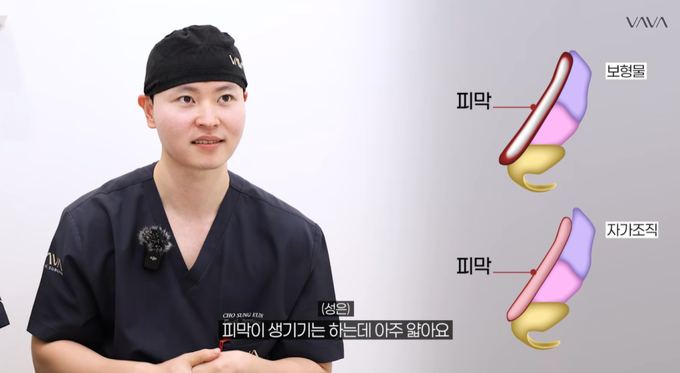 코성형 재료 총정리｜실리콘 부작용&middot;자가늑연골 와핑&middot;귀연골 흡수까지 (콧대 코끝 비교) 관련 이미지 11