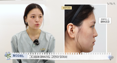 보형물 없이 선명하게｜바바성형외과 무보형물 매부리코 교정 리얼 후기 관련 이미지 4