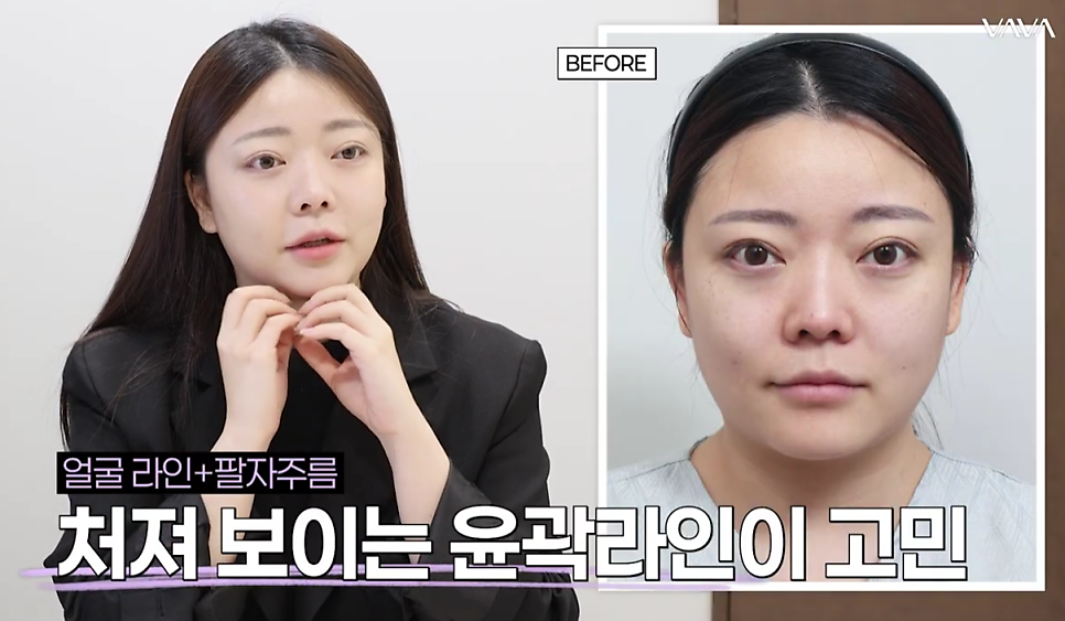 결혼식 전, 더 예쁜 나를 위한 작은 준비 (웨딩 시술 리얼 후기) 관련 이미지 10