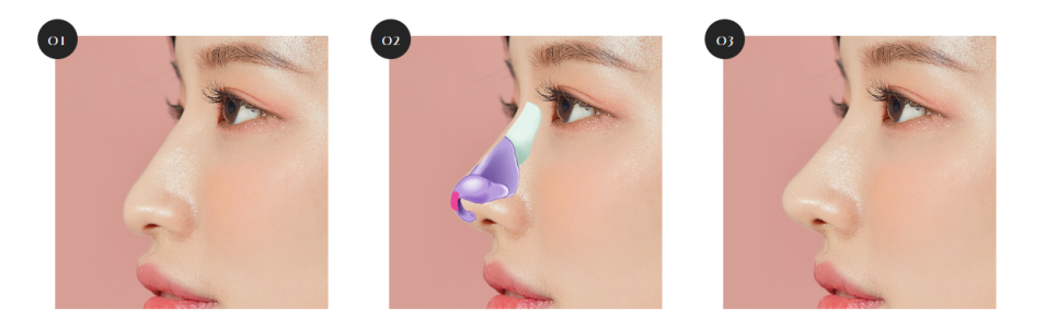 코 끝에 사용되는 주재료 관련 이미지 7