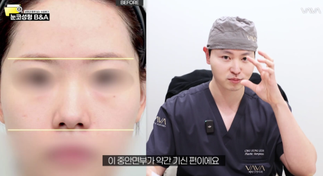 복코 매부리코 긴코 교정 ㅣ 코성형 전후 케이스 (NJZ민지 코) 관련 이미지 7