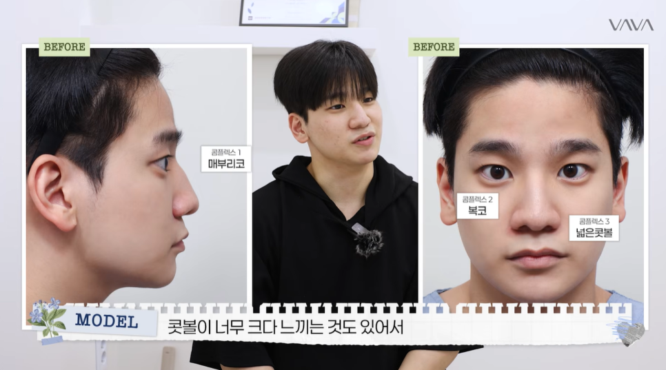 무보형물 직선라인 코성형으로 주먹코&middot;복코 개선｜압구정 바바성형외과 사례 관련 이미지 3