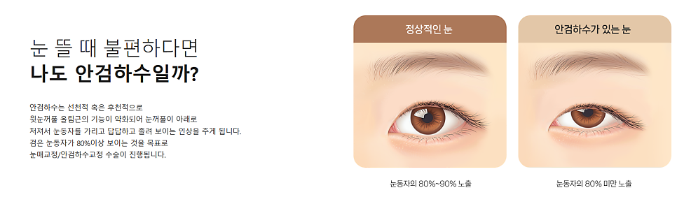 졸려 보이는 눈 안검하수 절개 쌍수 전후 차이 관련 이미지 3