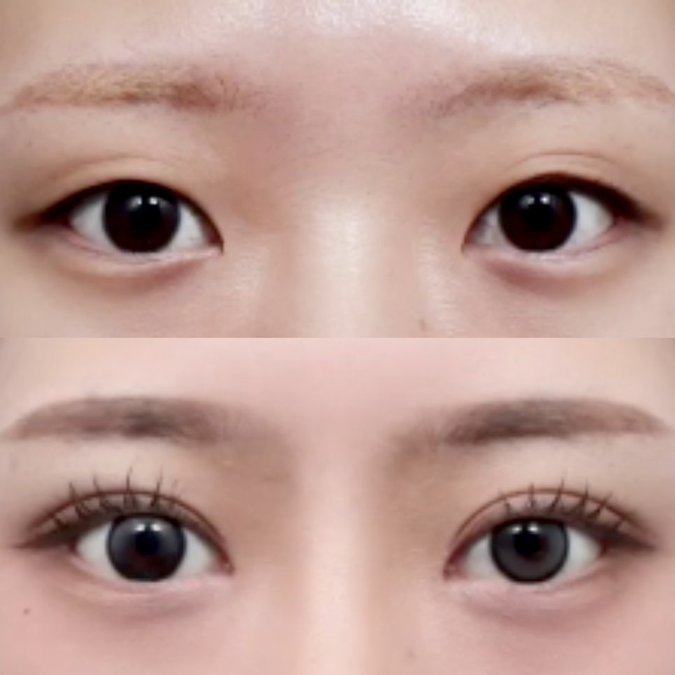 둔해보이는 눈매 무쌍 수술 전후 결과 알아보기 관련 이미지 5