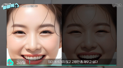 눈밑지방재배치 vs 하안검 vs 필러, 나는 어떤 케이스일까? | 압구정 바바성형외과에서 알려드립니다 관련 이미지 16