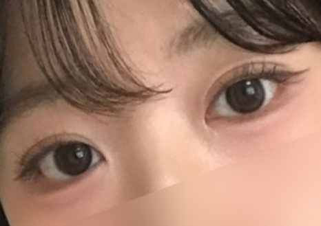 여름철 휴가 전 쌍꺼풀 수술 붓기 관리와 회복 TIP 관련 이미지 12