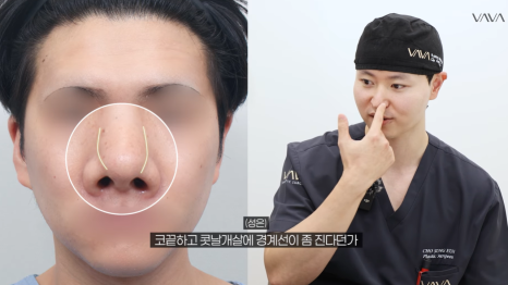 첫 코 성형, 언제&middot;어떻게 해야 할지 기준 정리해드립니다 관련 이미지 34