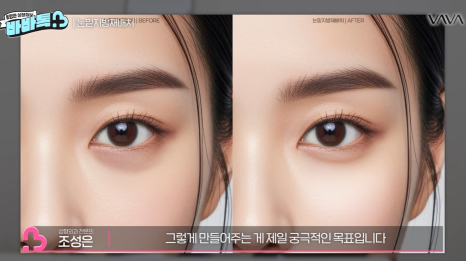 눈밑지방재배치 vs 하안검 vs 필러, 나는 어떤 케이스일까? | 압구정 바바성형외과에서 알려드립니다 관련 이미지 9