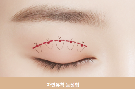 쌍꺼풀 수술 짧은 회복기 가능? 종류별 차이 완전 정리 관련 이미지 2