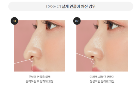 복코, 매부리코, 낮은코 | 바바성형외과 유형별 코성형, 내 코에 맞는 방향 찾기 관련 이미지 13