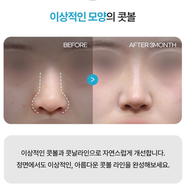 2026년 코성형 트렌드 예측콧대에서 코끝, 그리고 콧구멍까지 보는 시대 관련 이미지 4