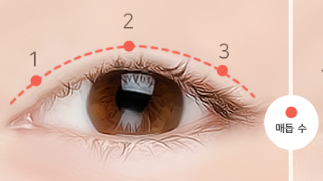 자연유착 vs 매몰 쌍꺼풀, 같은 비절개인데 왜 다를까요? 관련 이미지 2