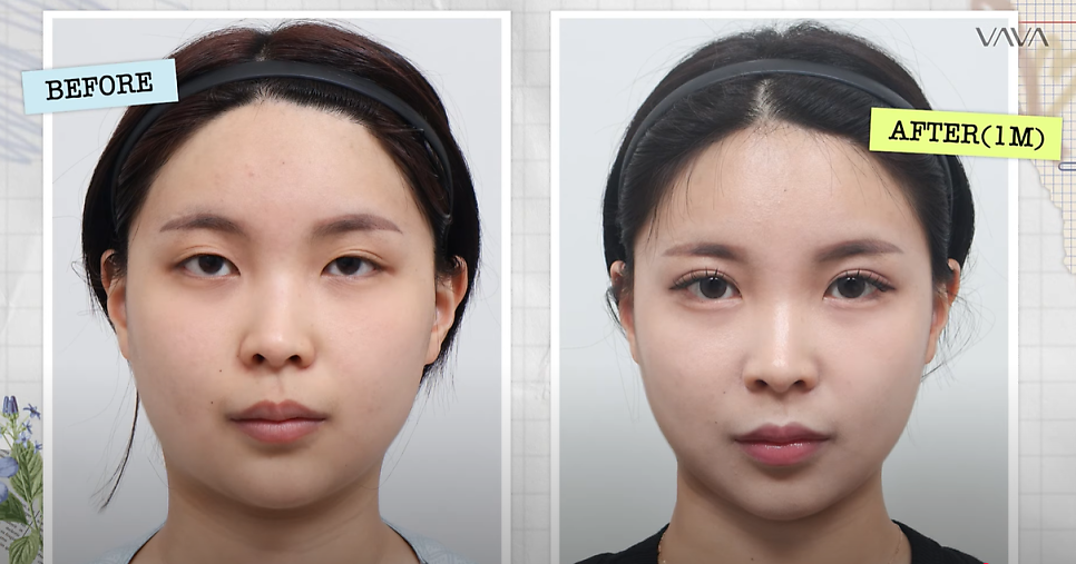 쌍수 재수술 성공기 ｜ 졸려보이는 눈 세미아웃으로 예뻐진 리얼 Before & After 관련 이미지 1