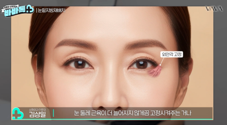 눈밑지방재배치 vs 하안검 vs 필러, 나는 어떤 케이스일까? | 압구정 바바성형외과에서 알려드립니다 관련 이미지 15