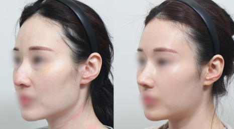 무보형 코성형 잘 어울리는 유형 관련 이미지 9