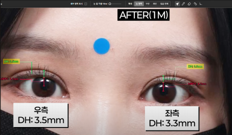 쌍꺼풀 재수술, 흉터 없이 가능할까? 관련 이미지 9