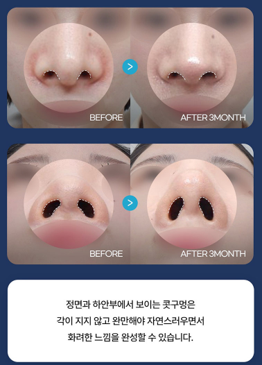 2026년 코성형 트렌드 예측콧대에서 코끝, 그리고 콧구멍까지 보는 시대 관련 이미지 11