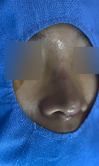 복코 수술전후 개선 된 인상 관련 이미지 6