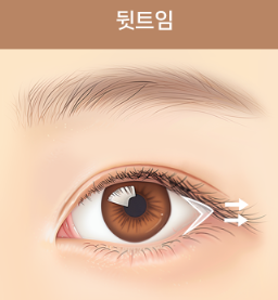 쌍꺼풀 수술만으로 충분할까? 눈 트임이 필요한 경우 관련 이미지 5