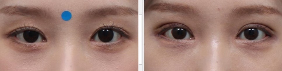 눈 유형별 맞는 쌍수 알아보기 관련 이미지 3