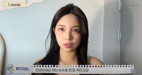 쌍수 재수술 성공기 ｜ 졸려보이는 눈 세미아웃으로 예뻐진 리얼 Before & After 관련 이미지 13