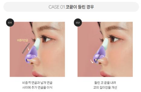 복코, 매부리코, 낮은코 | 바바성형외과 유형별 코성형, 내 코에 맞는 방향 찾기 관련 이미지 20