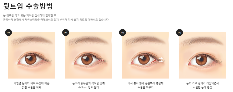 트임이 필요한 눈매와 트임 수술법 관련 이미지 7