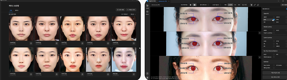 바바성형외과 절개 쌍수 절개 눈매교정 쌍꺼풀  재수술  사례 관련 이미지 5