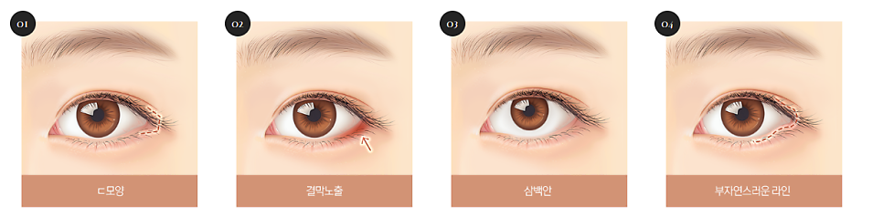 트임이 필요한 눈매와 트임 수술법 관련 이미지 10