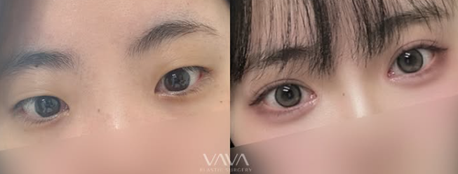 쌍꺼풀 수술만으로 충분할까? 눈 트임이 필요한 경우 관련 이미지 11