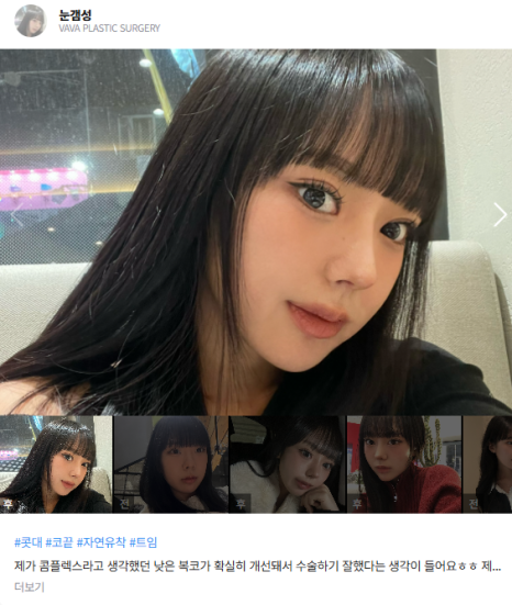 압구정 눈성형, 자연스럽게 달라지는 첫인상 관련 이미지 14