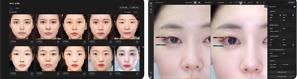 자연유착 VS 절개  어떤 기준으로 선택해야 할까? 관련 이미지 6