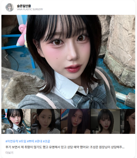 압구정 눈성형, 자연스럽게 달라지는 첫인상 관련 이미지 13