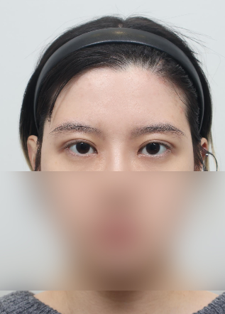 졸려 보이는 눈 안검하수 절개 쌍수 전후 차이 관련 이미지 5