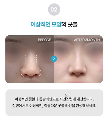 압구정 바바성형외과 코성형 &ndash; 정면&middot;측면 모두 고려한 코라인 설계 관련 이미지 11