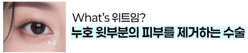 쌍수만으로 충분할까? 윗트임 병행이 필요한 경우 관련 이미지 2