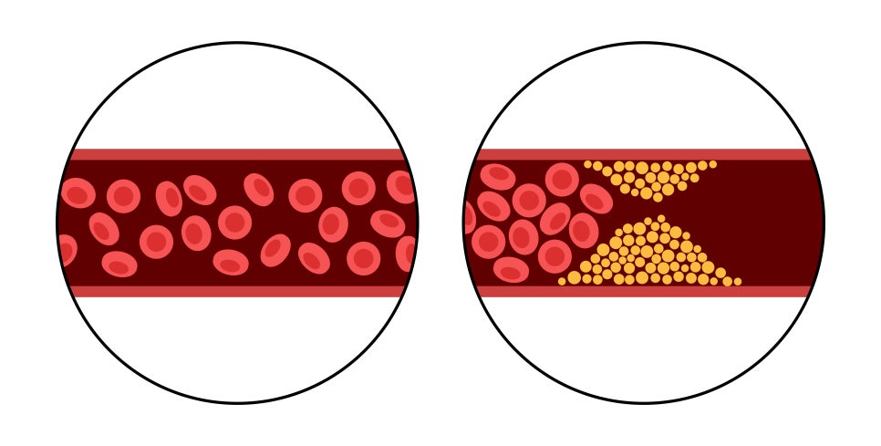 코 성형 후 붓기 기간과 붓기 관리방법 관련 이미지 2