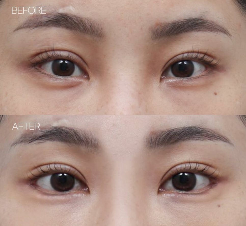 눈 유형별 맞는 쌍수 알아보기 관련 이미지 2