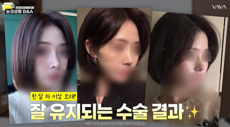 복코 매부리코 긴코 교정 ㅣ 코성형 전후 케이스 (NJZ민지 코) 관련 이미지 24