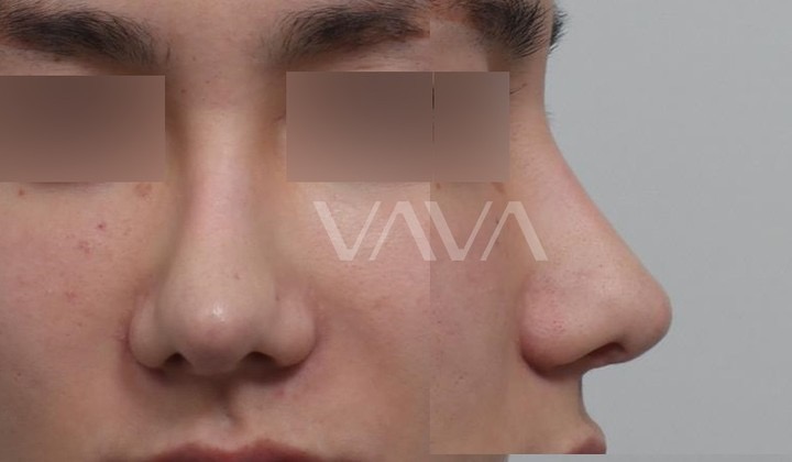 첫 재수술 실패로 잃어버린 코 라인 되찾기 관련 이미지 4