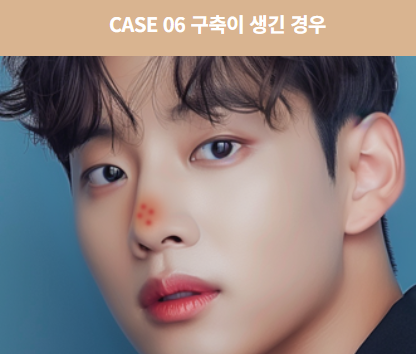 코 재수술, 첫 수술보다 더 신중해야 하는 이유 관련 이미지 11