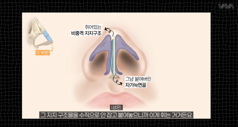 코성형 재료 총정리｜실리콘 부작용&middot;자가늑연골 와핑&middot;귀연골 흡수까지 (콧대 코끝 비교) 관련 이미지 19