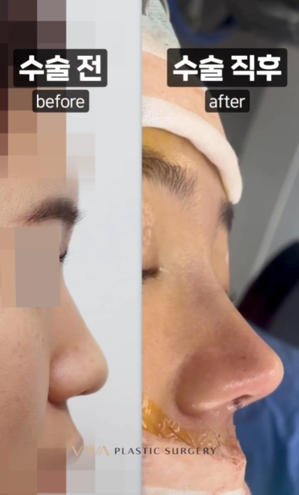 코 성형 후 붓기 기간과 붓기 관리방법 관련 이미지 6