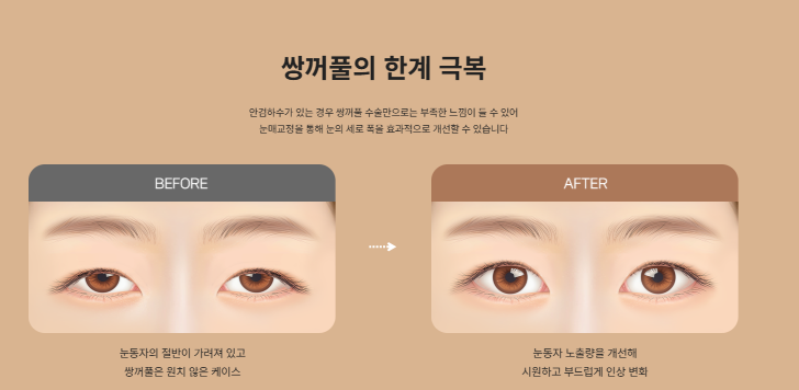 압구정 눈성형, 자연스럽게 달라지는 첫인상 관련 이미지 6