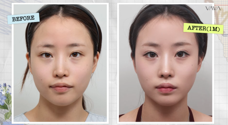 코재수술로 인상까지 달라질 수 있을까?｜바바성형외과 직반라인 코재수술 후기 관련 이미지 16
