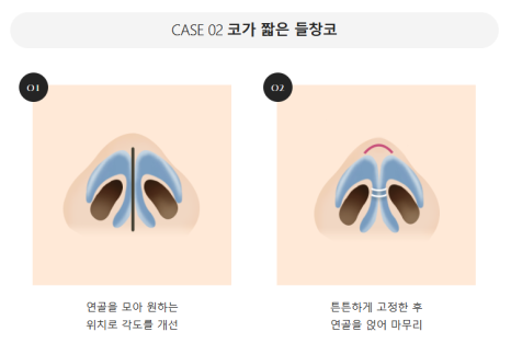 입체적이고 균형 잡힌 코 라인을 위한 자가연골 코 성형(비중격, 귀연골, 늑연골) 관련 이미지 12