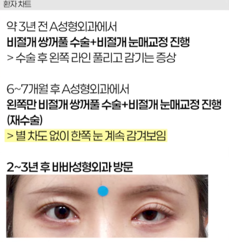 쌍수 후 생겨버린 짝눈 교정 눈의 균형을 맞추는 섬세한 방식 관련 이미지 11