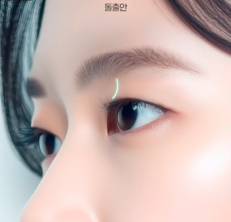 자연유착 VS 절개  어떤 기준으로 선택해야 할까? 관련 이미지 19